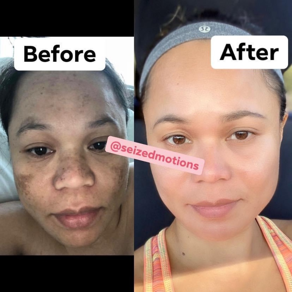 Anti Melasma Toner, Soap, Cream & Sunblock Kit Set